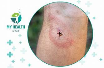Lyme disease