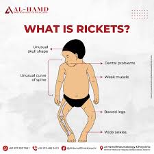 Rickets