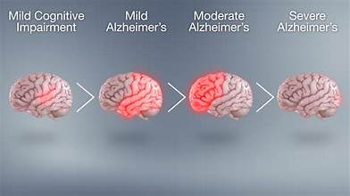Alzheimer’s disease (AD)