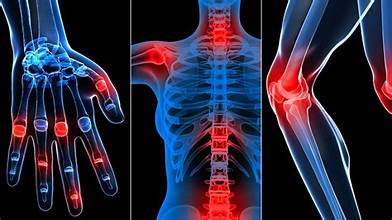 Arthritis