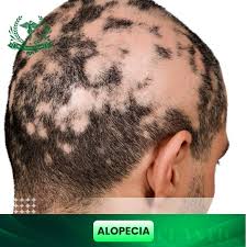 Alopecia